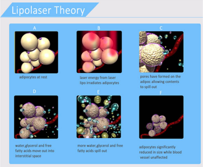 how lipolaser works.png