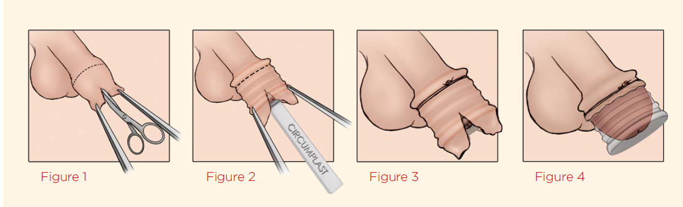 Circumcision device,ster,s.u.16mm,PAC-50