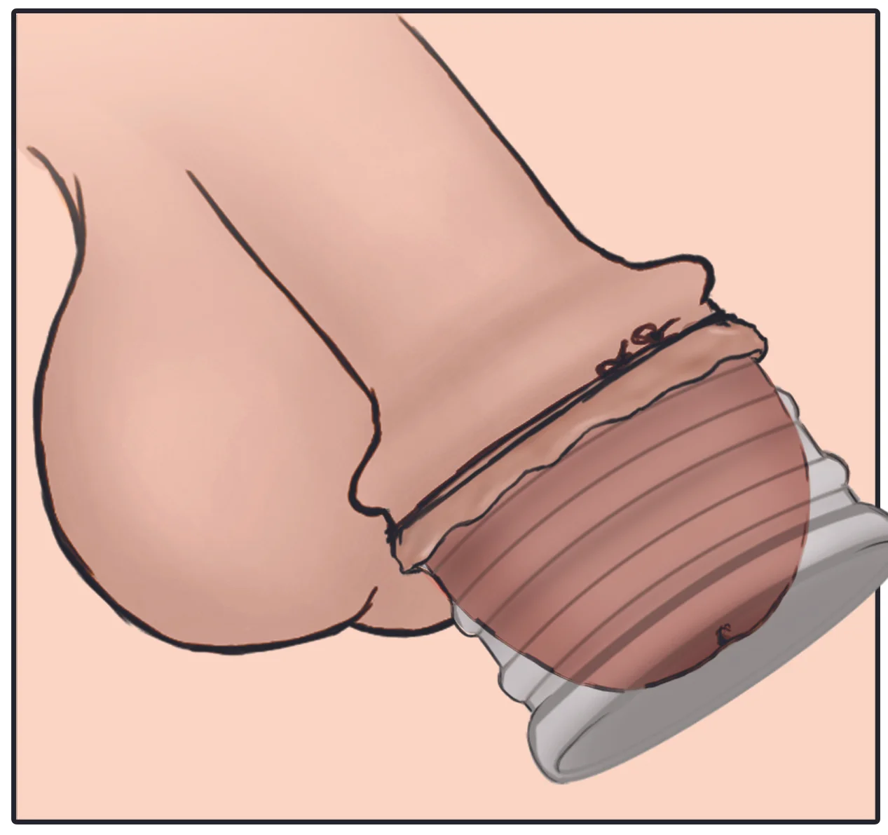 Circumcisions with Circumplast has reached to 1000 in number at Thornhill and London (Leyton and Croydon) clinic in October 2016