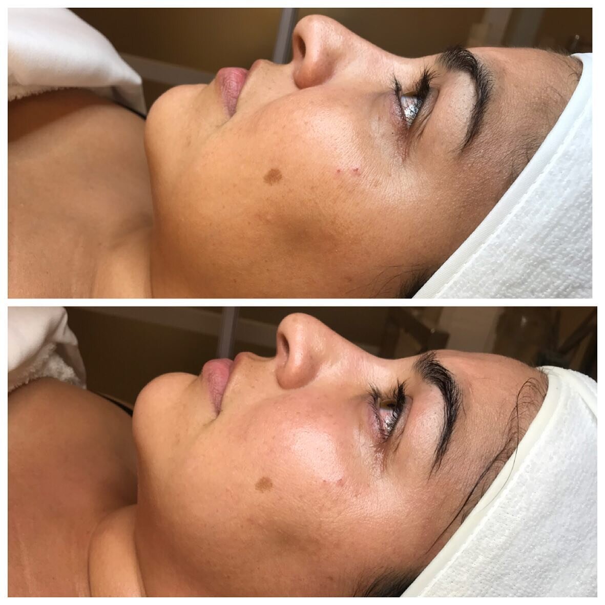 Dehydration leads to sallow skin with a slight gray undertone. After a treatment I love when skin comes back to life and it looks bouncy and fresh.jpg