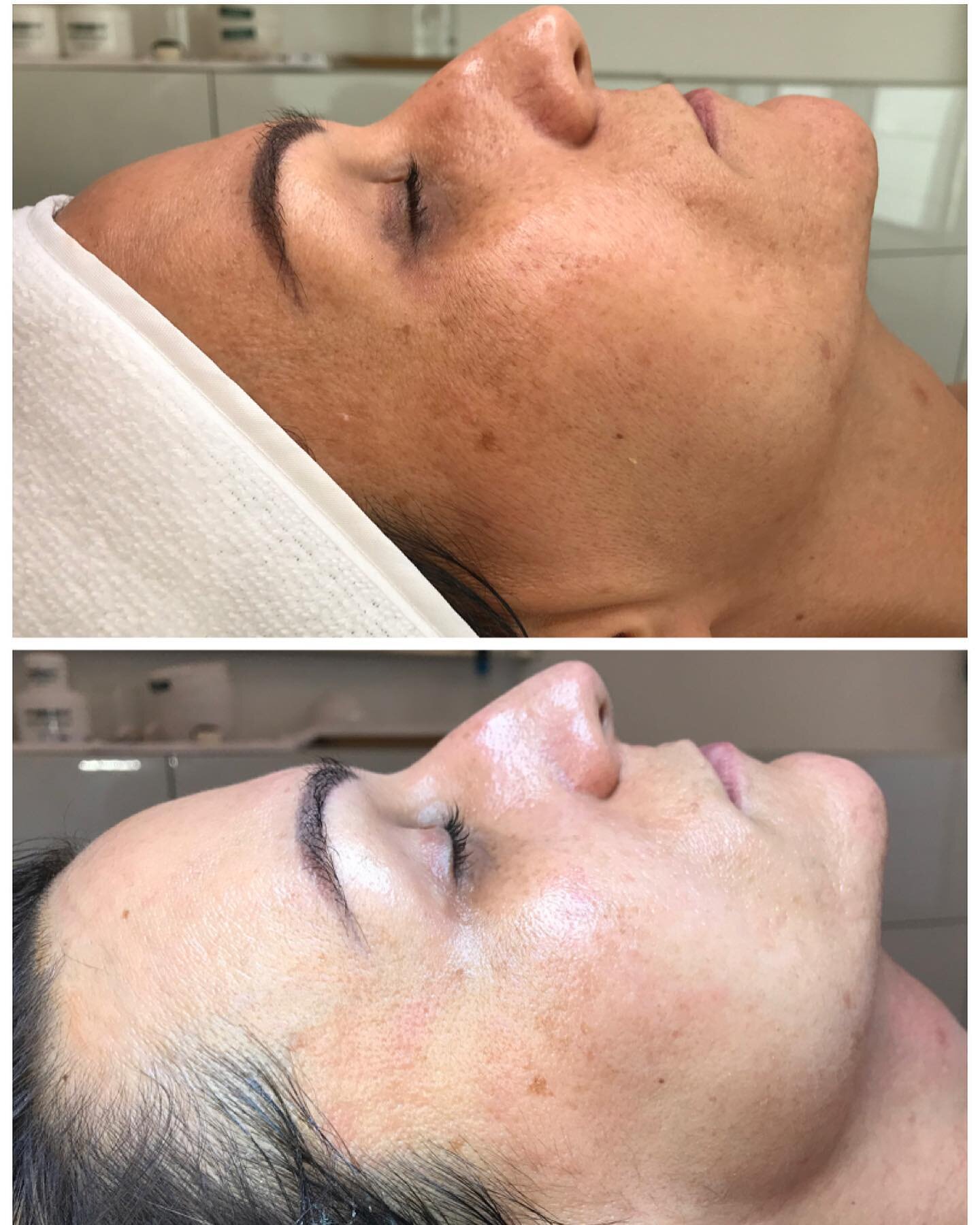 Bye bye brown spots under eye circles and tired skin -Welcome to Blume featuring DMK No filter needed here! This is one treatment I can’t wait to see her in 4 weeks - She is using prescribed home care and I know it will be transformative.jpg