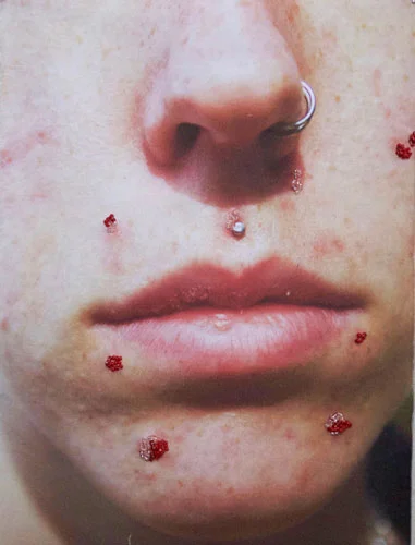 beaded-zits.jpg