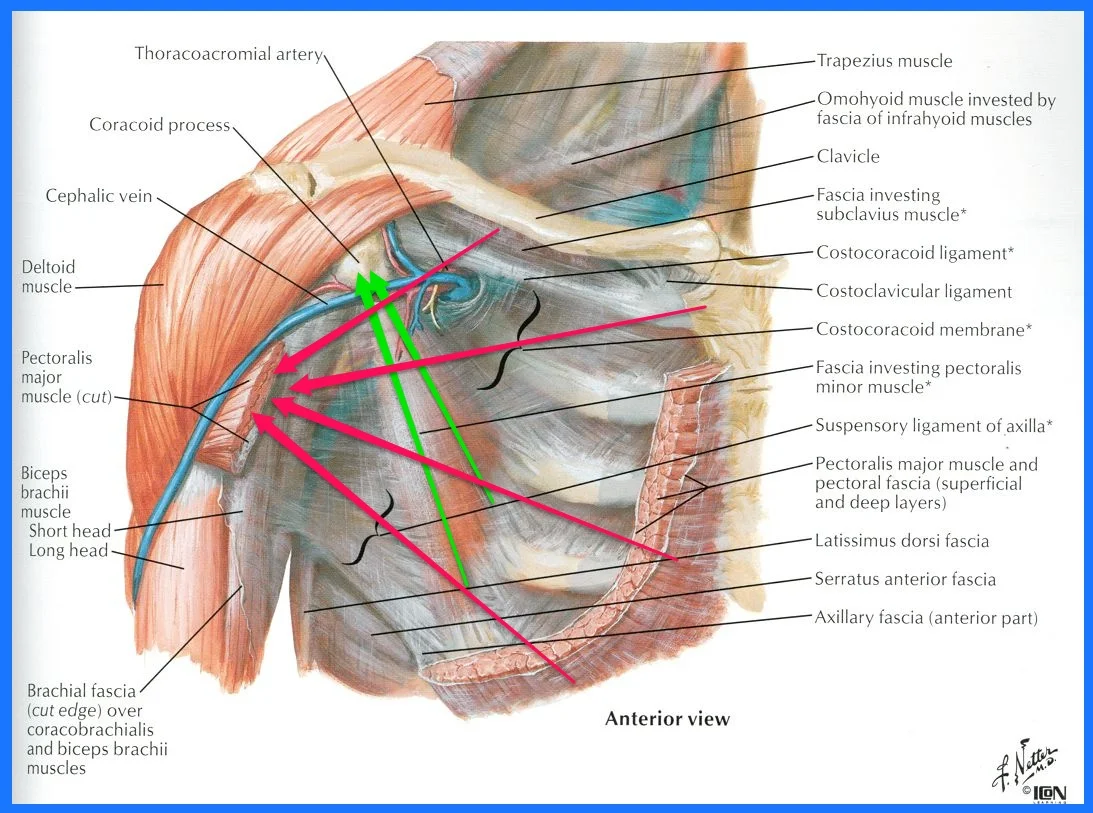 Pectoralis Spasm Due to Poor Posture