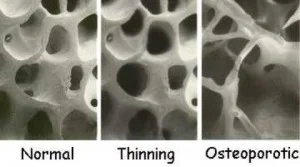 osteoporosis personal trainer Currumbin.jpg