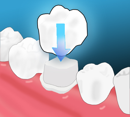 Crown being placed over prepared tooth
