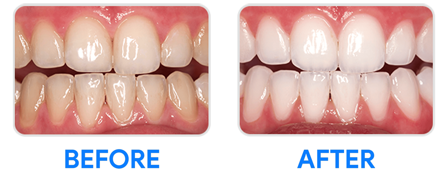 Teeth Whitening in Laredo, TX Gentle Family & Implant Dentistry — Best