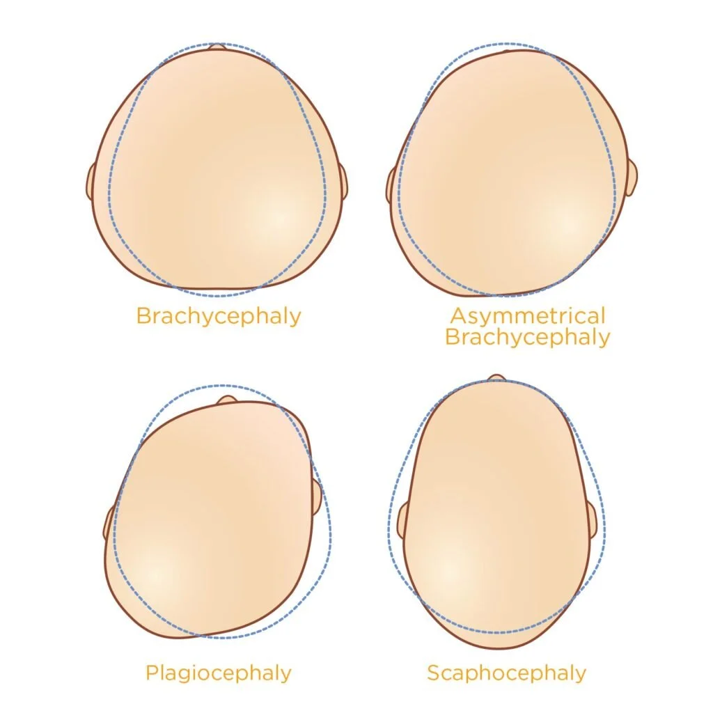 types of plagiocephaly