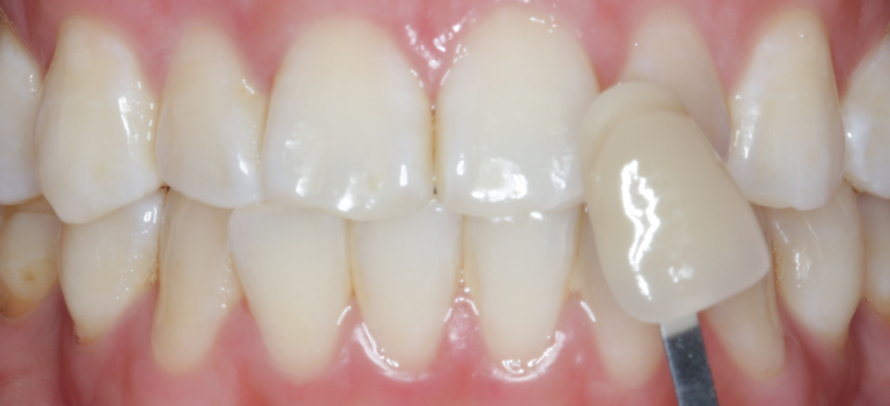 After in-chair whitening and 1 week of take-home whitening.