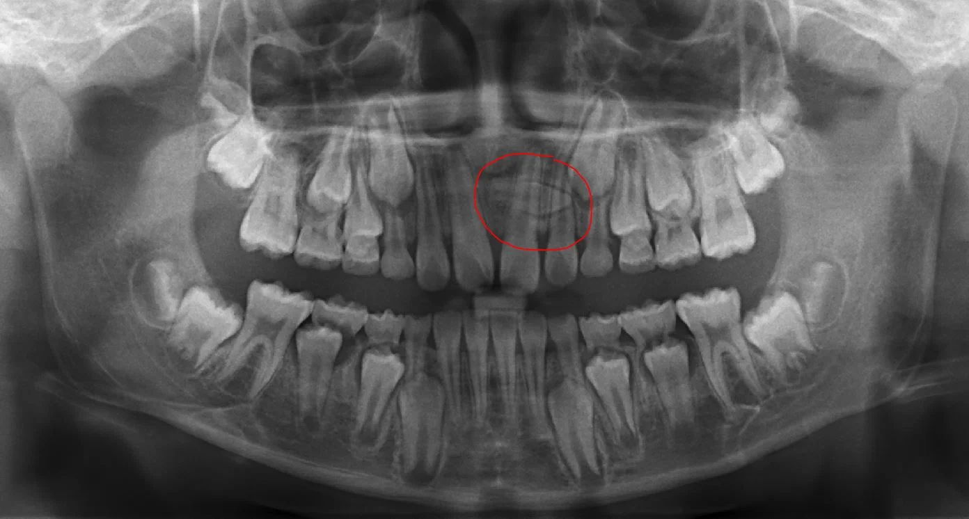 This x-ray shows an extra tooth in a child. It cannot be picked up without x-rays.