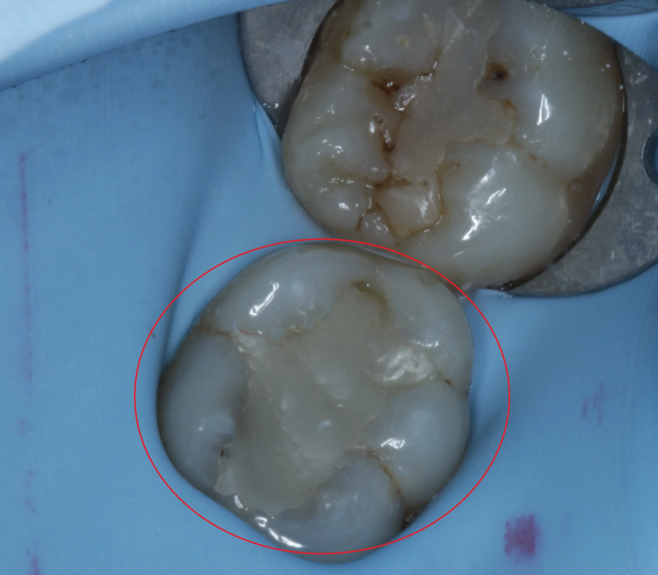 The tooth on the left side had decay and residual amalgam underneath the white filling. Note the staining and minor chipping of the filling on the other tooth, which eventually will require to be redone, but is still acceptable for now.