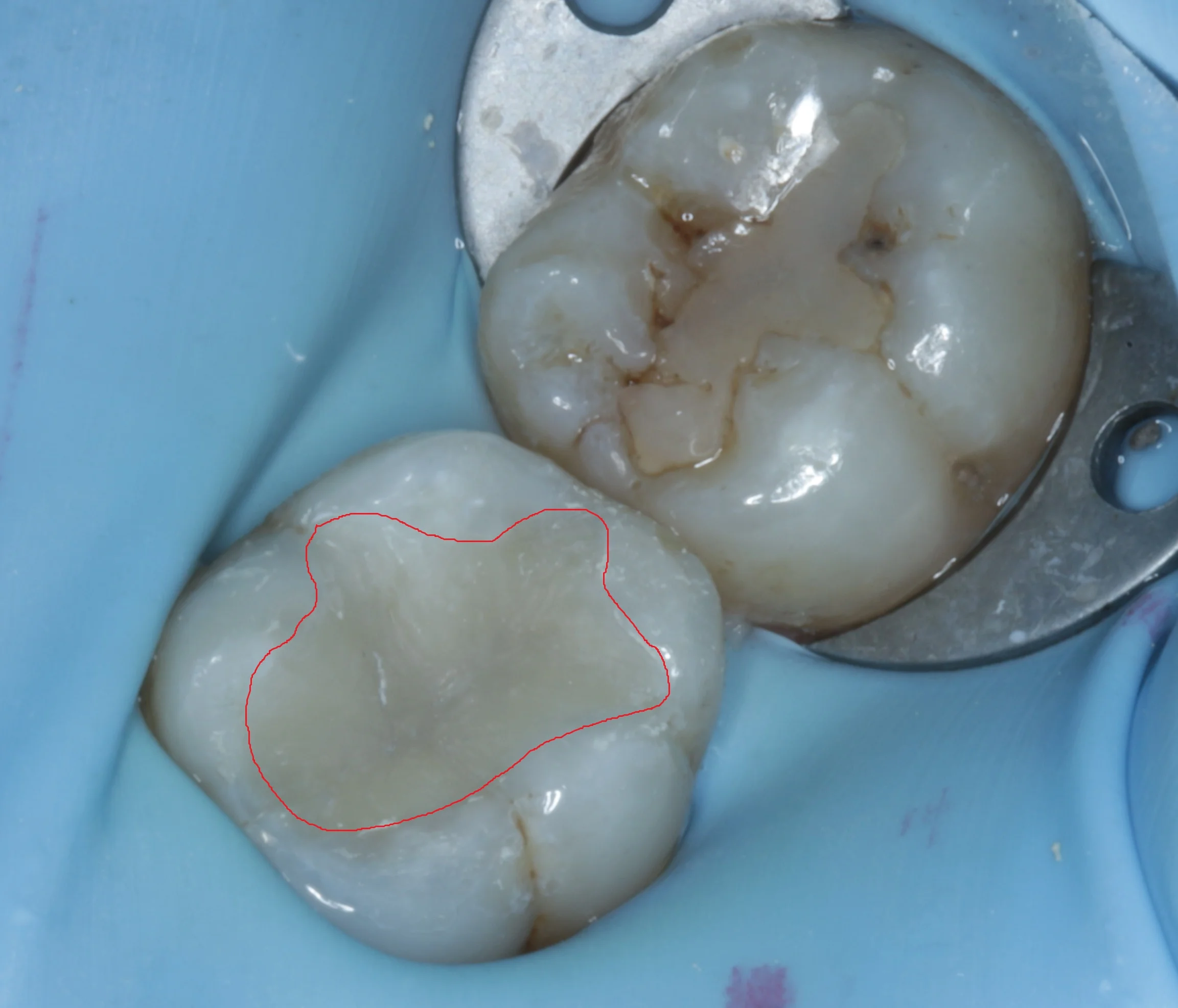 This is the tooth with the new filling. I had removed all the decay and amalgam. The filling is also shaped to be more like a natural tooth, for better chewing efficiency and aesthetics.
