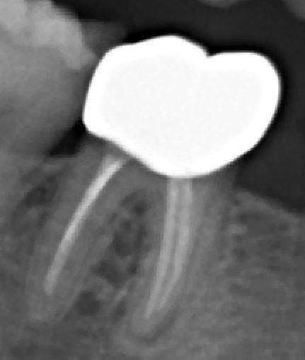 This is an x-ray of a tooth with a crown on it. The metal of the crown totally obscures what is inside!
