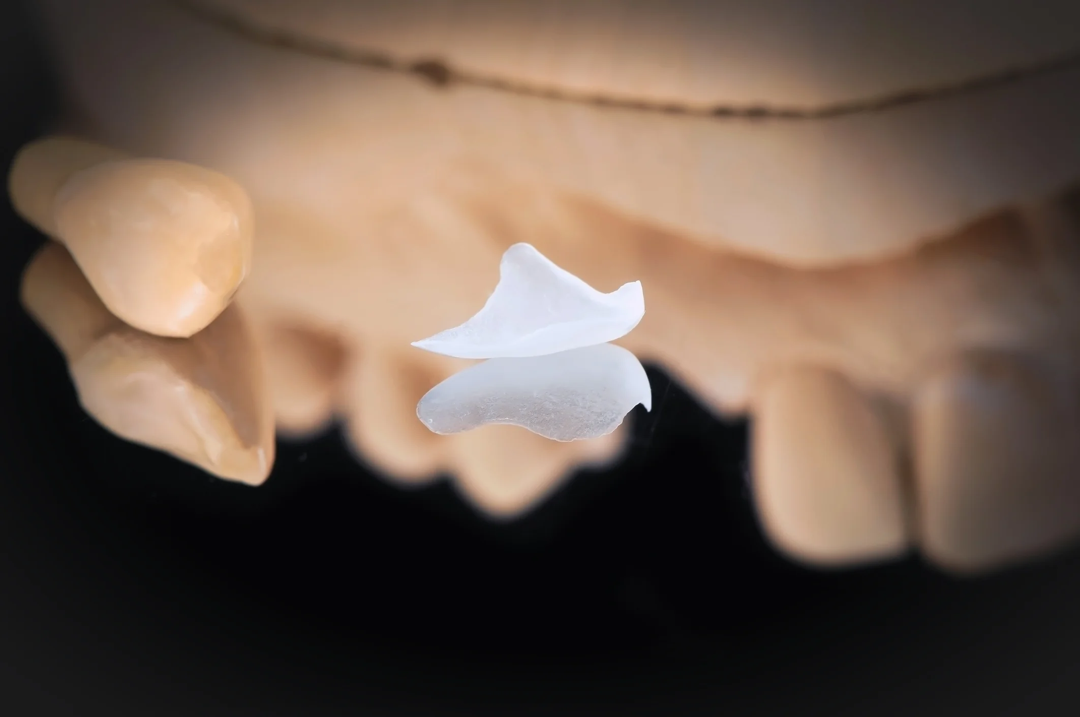 Veneers can be made extremely thin, to be more conservative to your teeth.