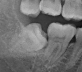 This wisdom tooth needs to be removed. It will likely cause tooth decay in the tooth in front of it!