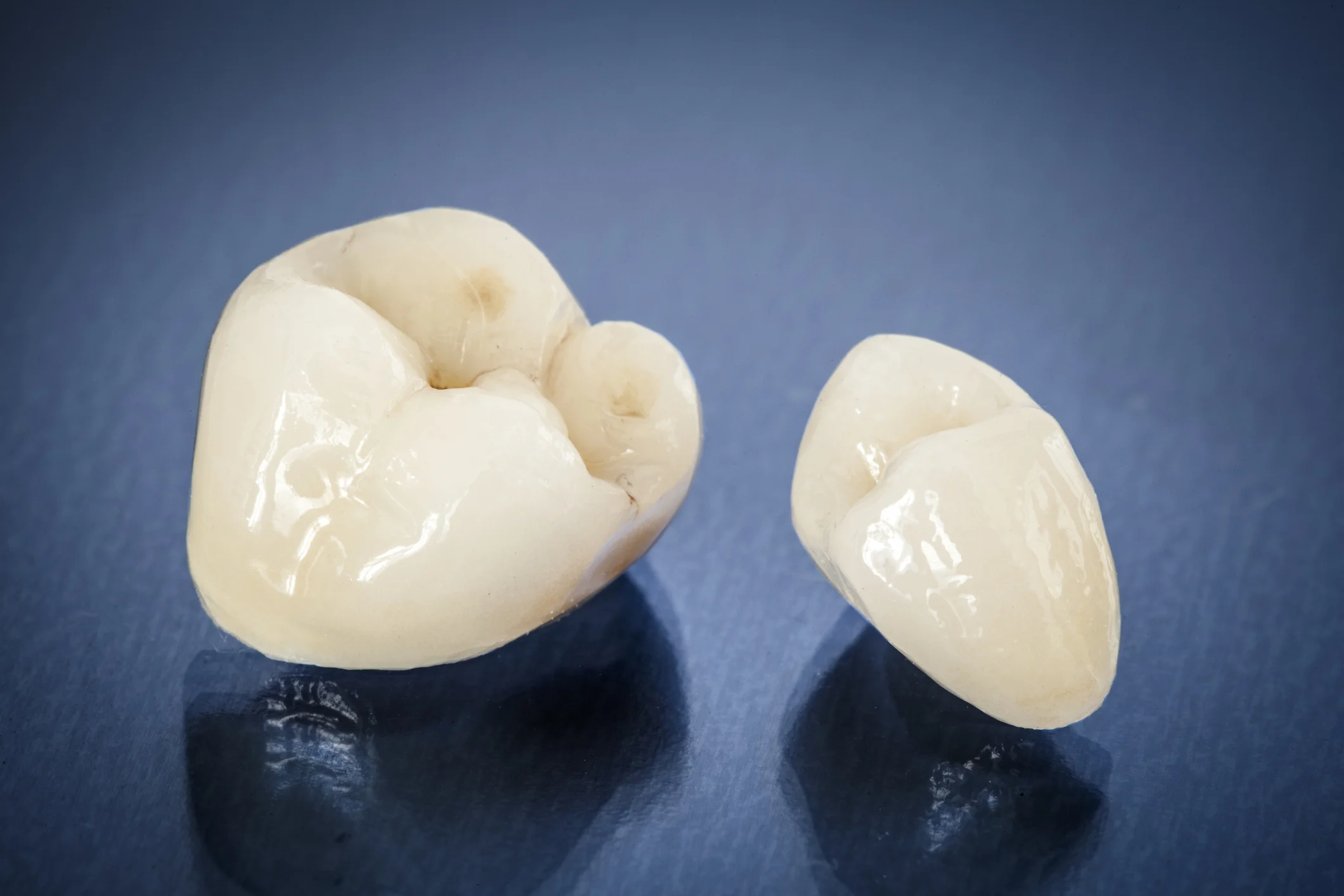 These all ceramic crowns look and feel exactly like natural teeth. Our crowns are made locally by a highly skilled ceramist in Sydney.
