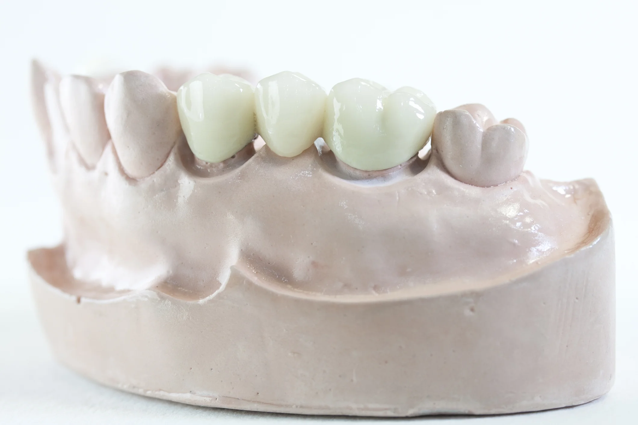This traditional bridge replaces the missing natural tooth in the middle.