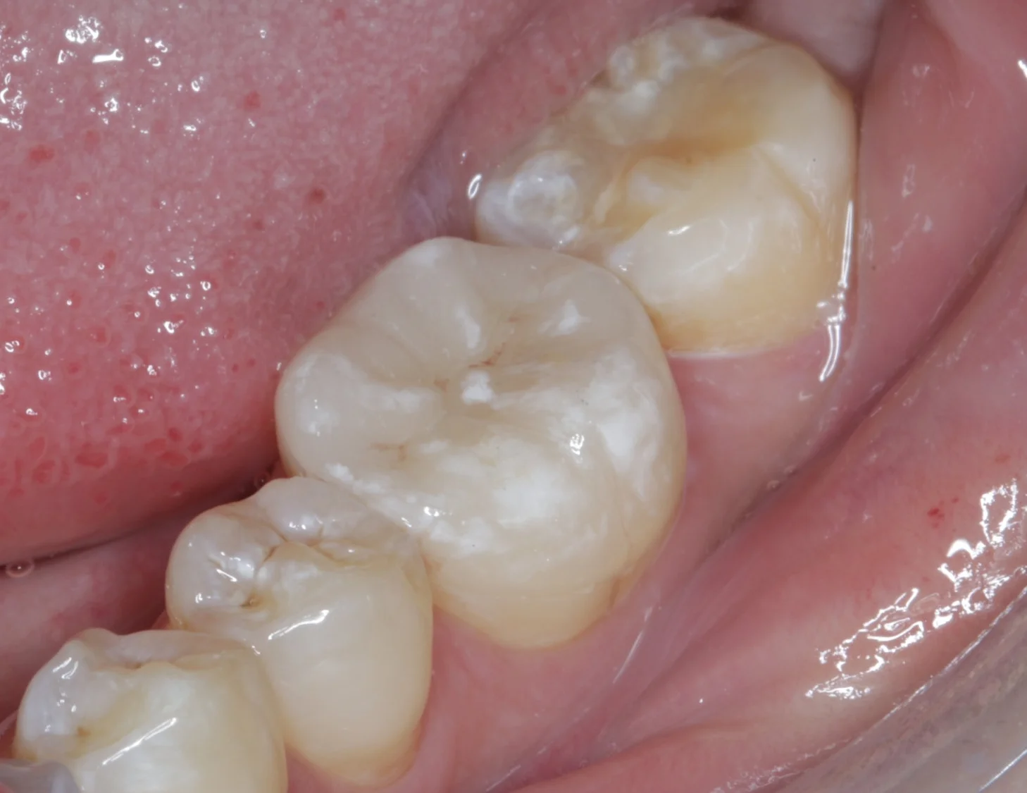 One of these teeth have a crown on it, that I did. Can you tell which one has the crown?