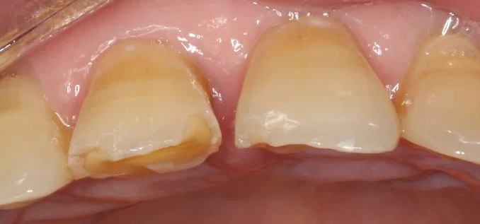 This is an actual case of mine. He had a bad habit of biting crab shells with his front teeth, which caused so many chips. I don't have a photo of a better angle unfortunately.