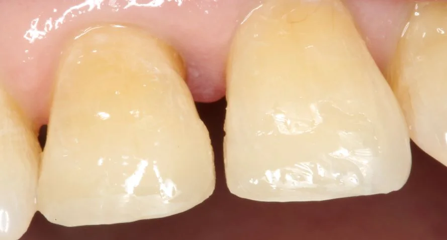 These are those same teeth, restored with composite resin. I have kept the gap that would have been there with his natural teeth, so it all looks natural!