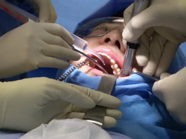 Wisdom tooth removal in progress