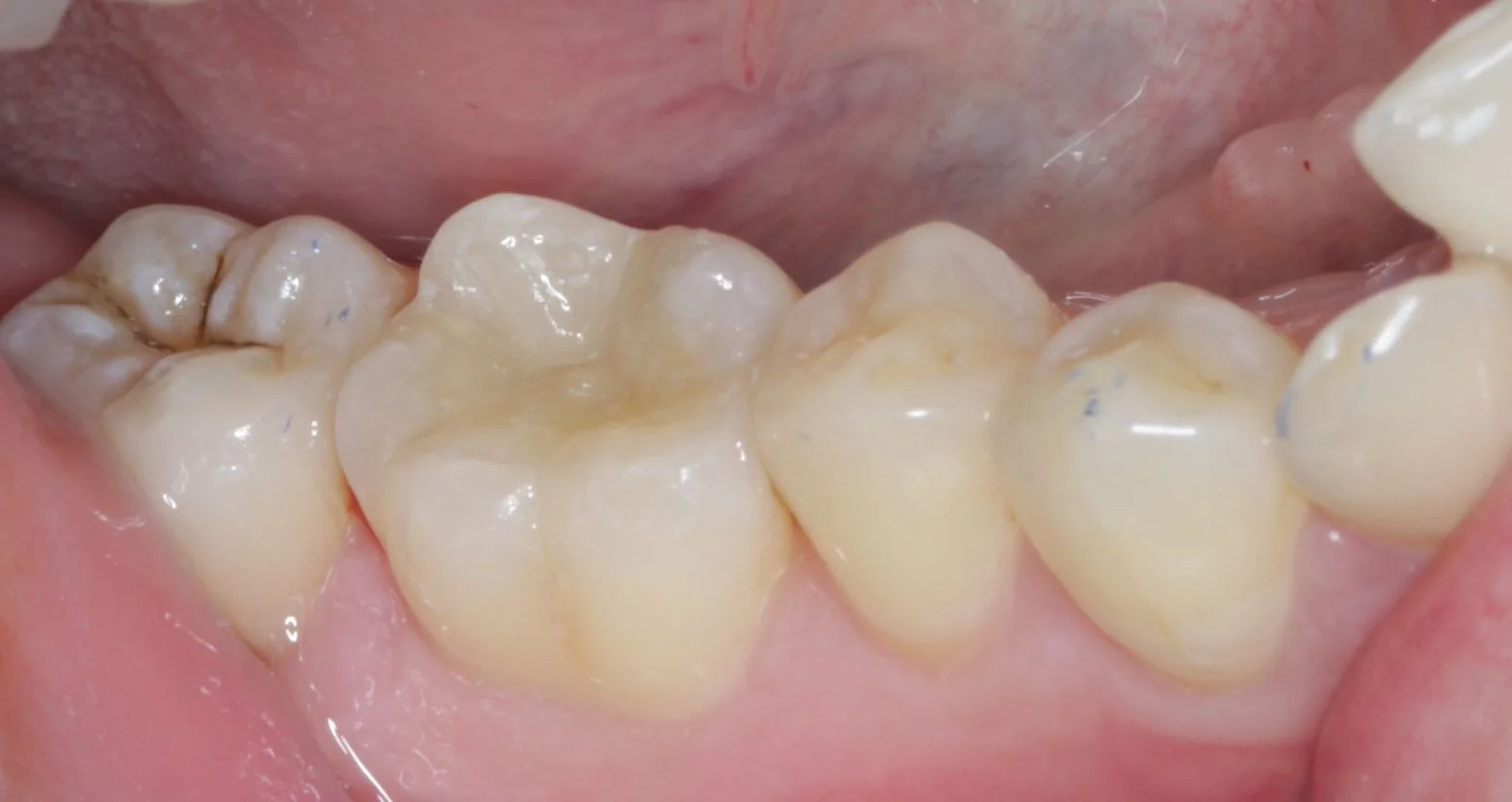This first molar (biggest tooth in the middle of the photo) has a porcelain onlay by Dr Cheuk. It is most aesthetic and long lasting.