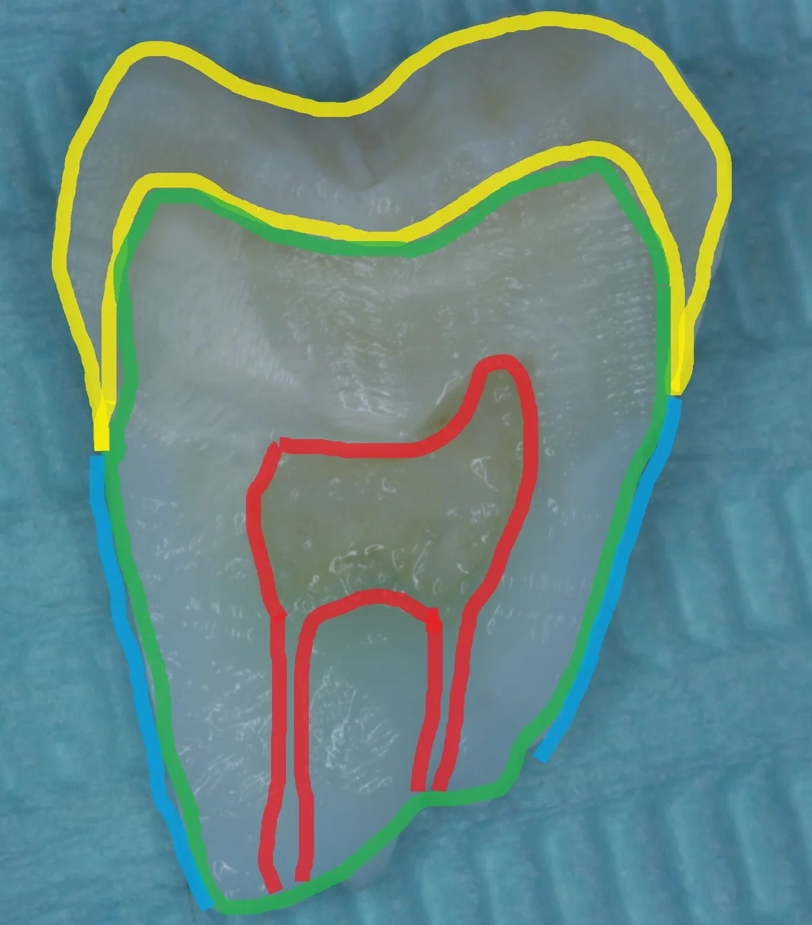 Photo of a tooth sectioned in half with parts of it highlighted to show different parts