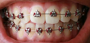Braces