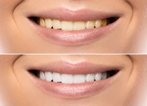 An obviously photoshopped image of teeth whitening. The smiles are 100% the same in position and size. Don’t trust everything you see online! Such a dramatic difference is rarely achieved in reality.