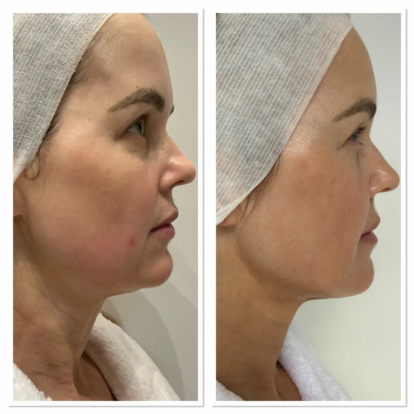 Benefits of HIFU at Skin Day Spa.

HIFU (High-Intensity Focused Ultrasound) is the ultimate non-surgical lift&mdash;designed to firm, sculpt, and rejuvenate the skin from within, without downtime.

Lift &amp; tighten without surgery. 
HIFU works deep