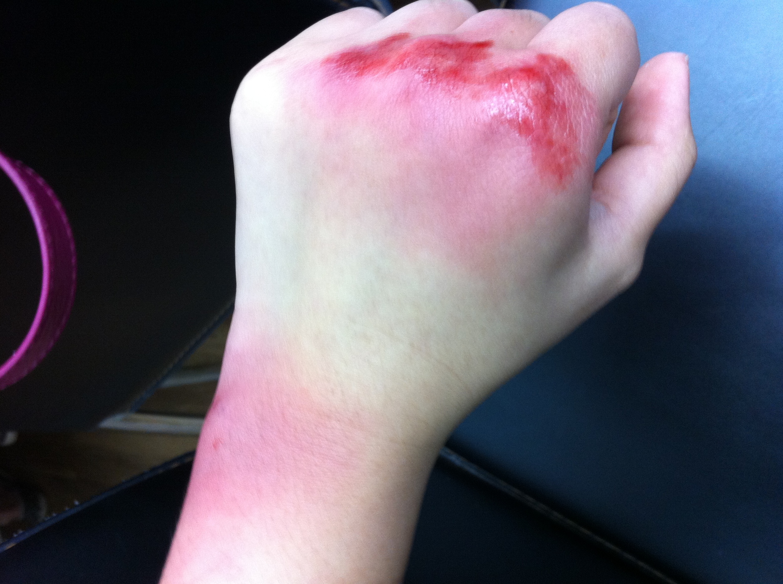 Bruise
