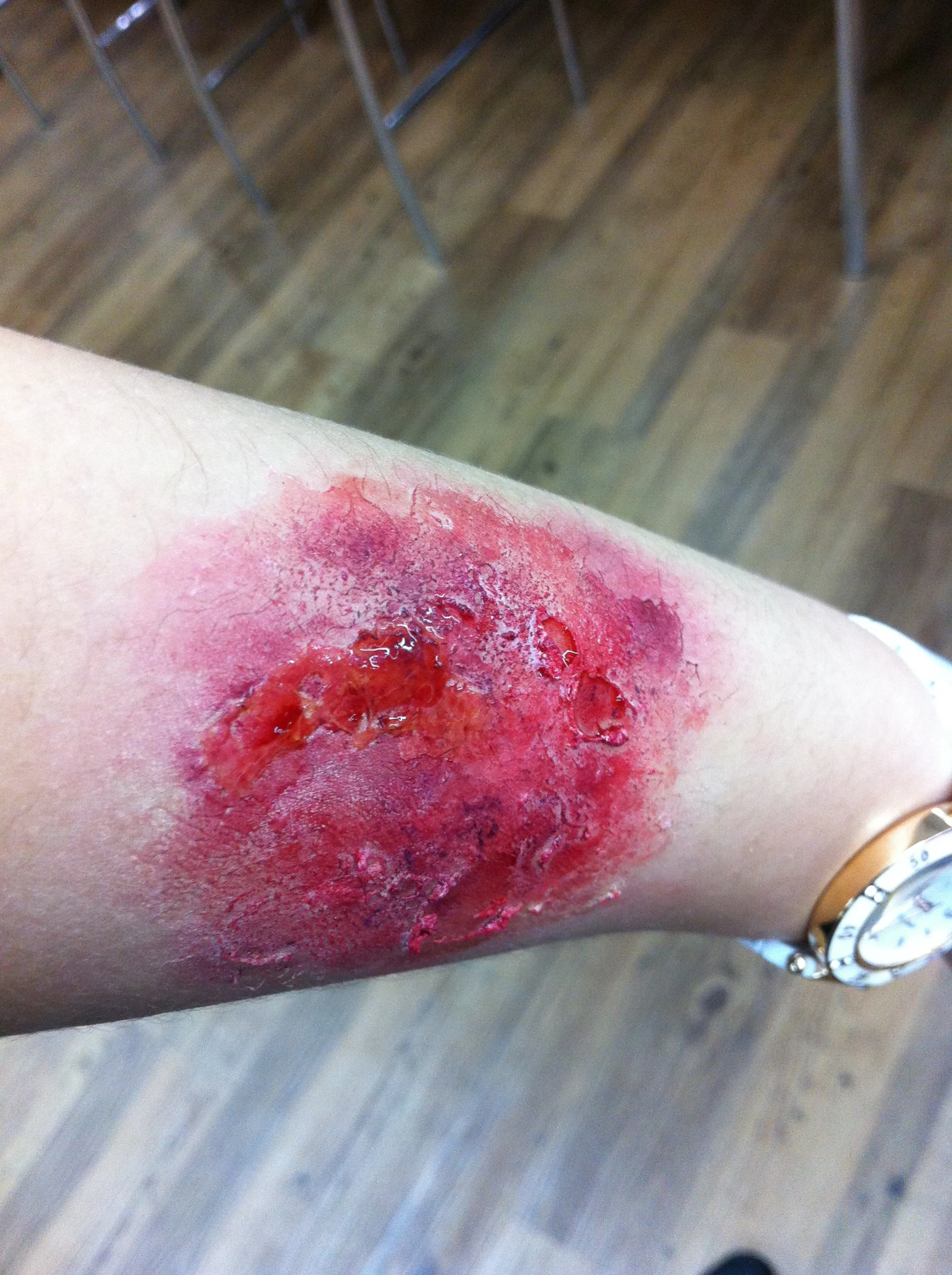 Burns and blisters