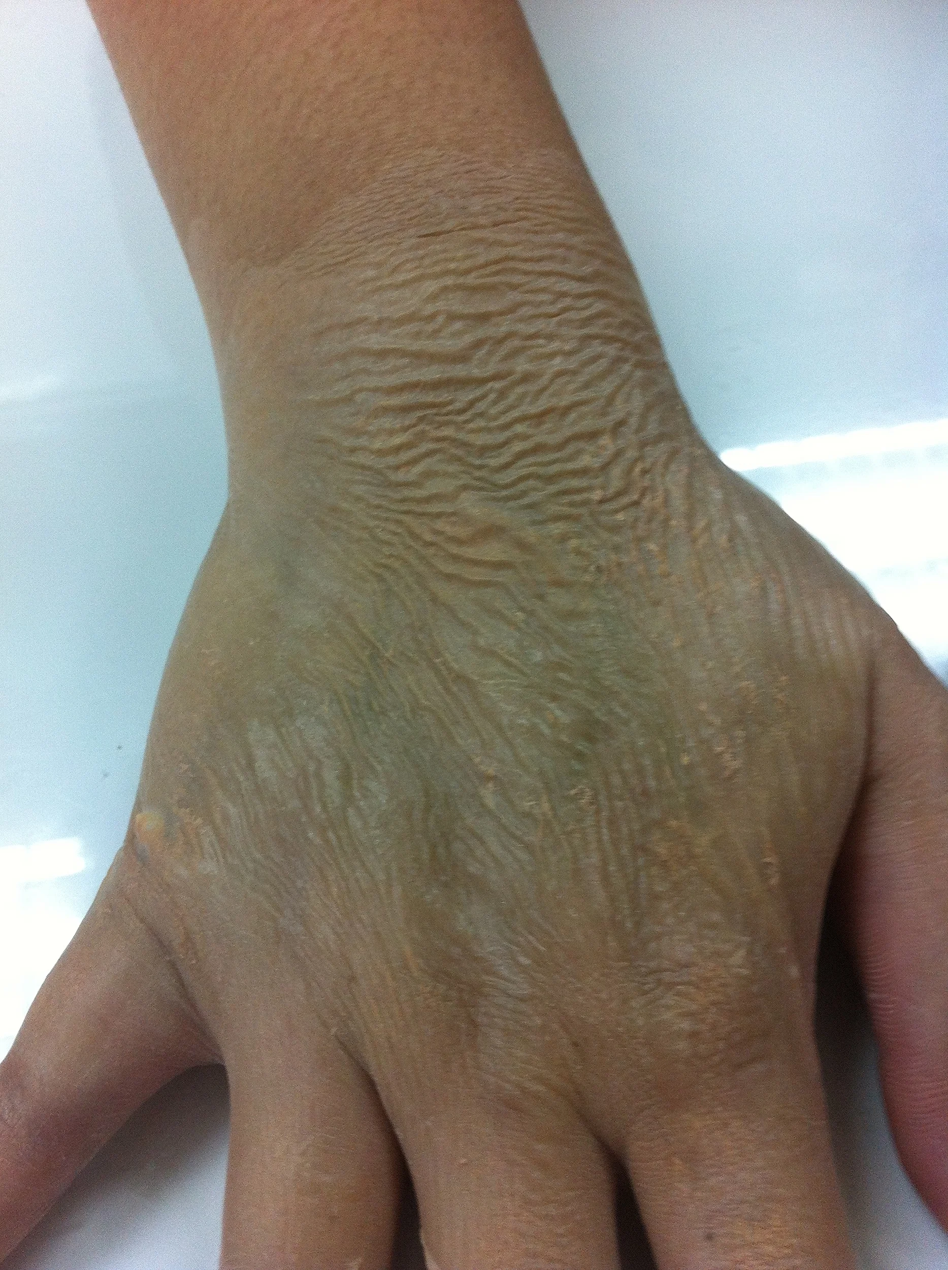 Ageing skin