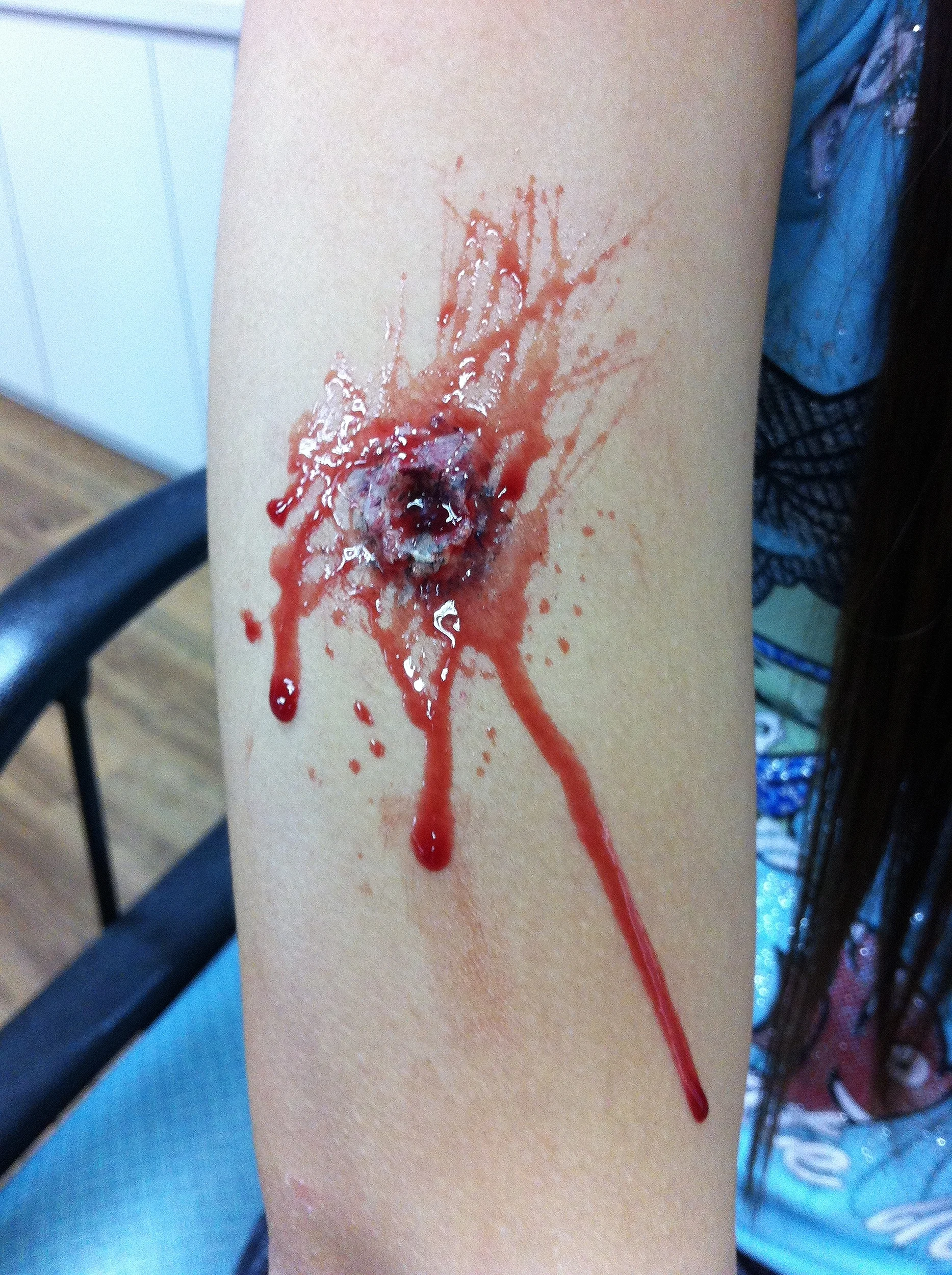 Gunshot wound
