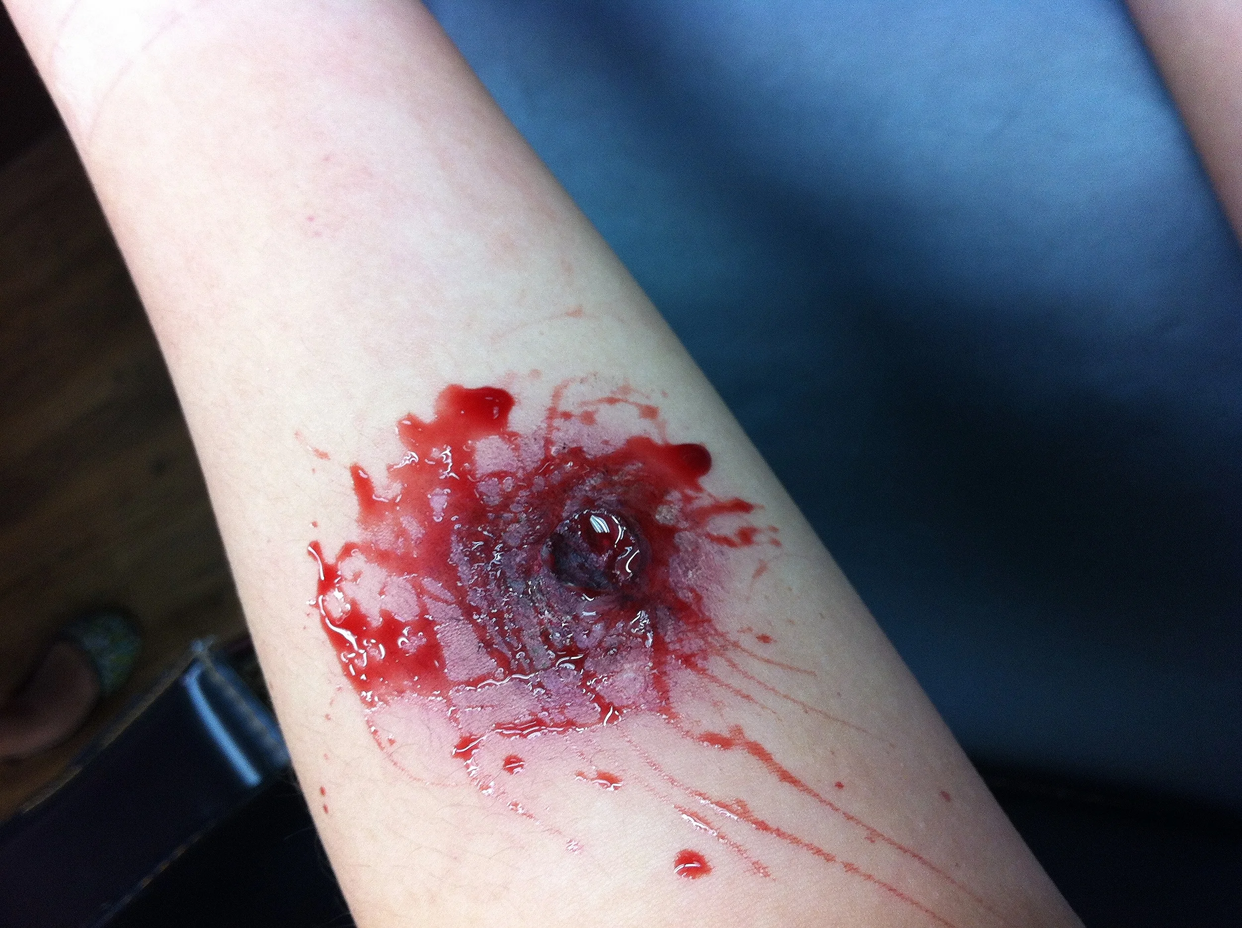 Gunshot wound