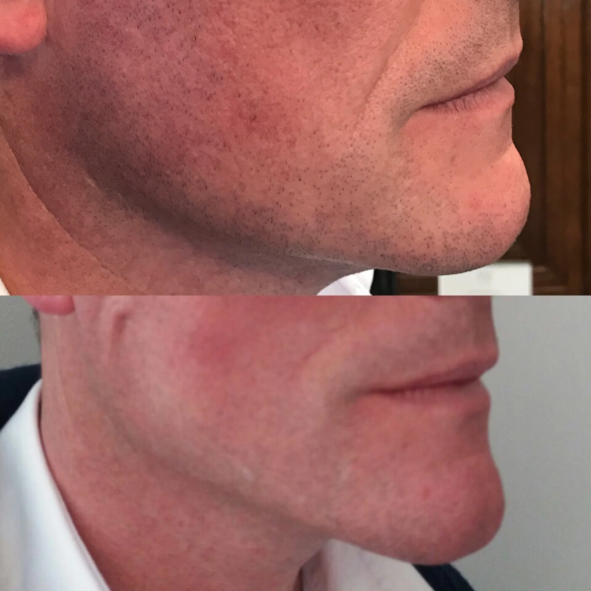 pdobeforeafter.jpg