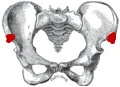 Pelvic bowl with ASIS marked