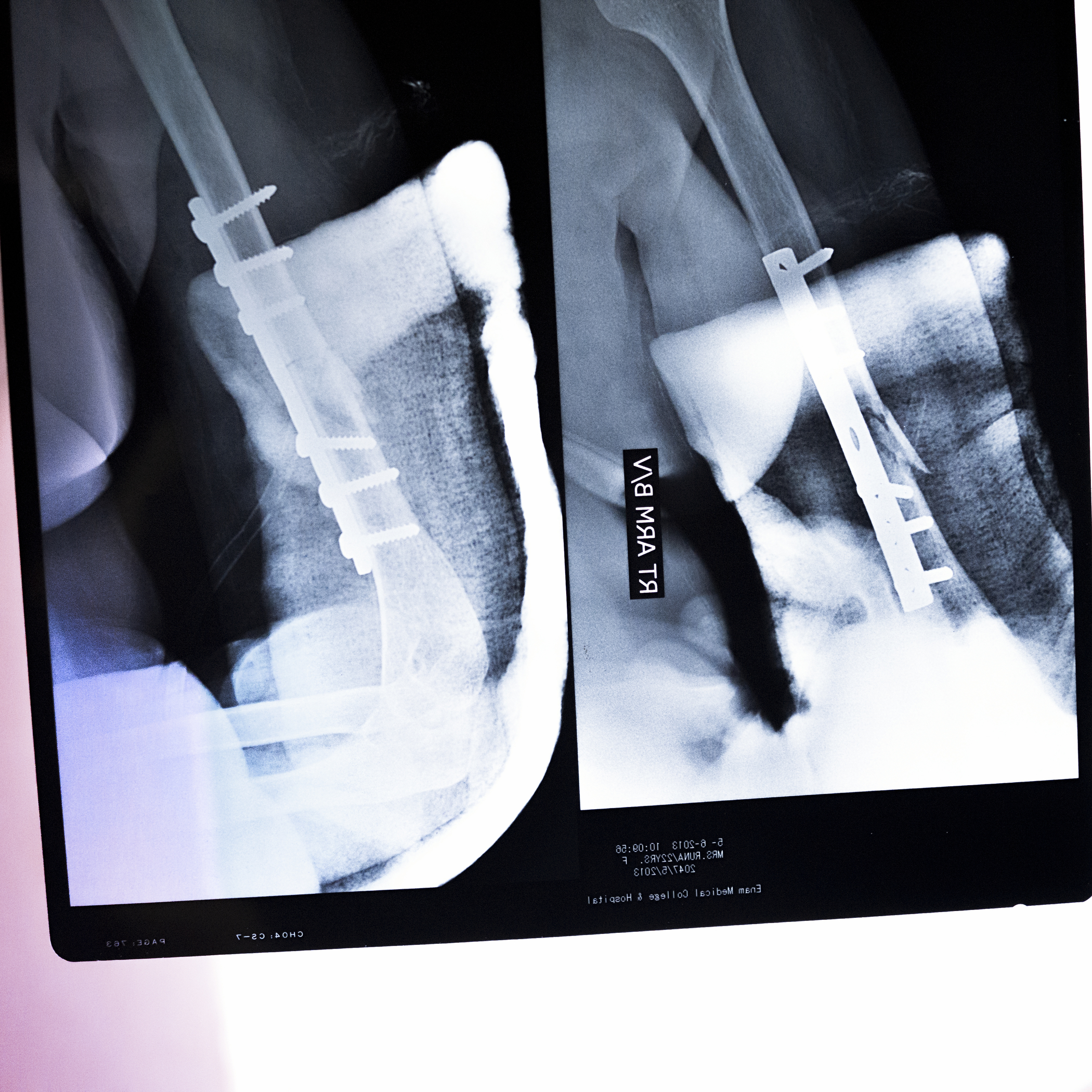 The X-ray plates of Runa Akhtar’s wounded hand