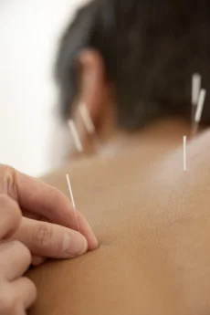 The Benefits of Acupuncture