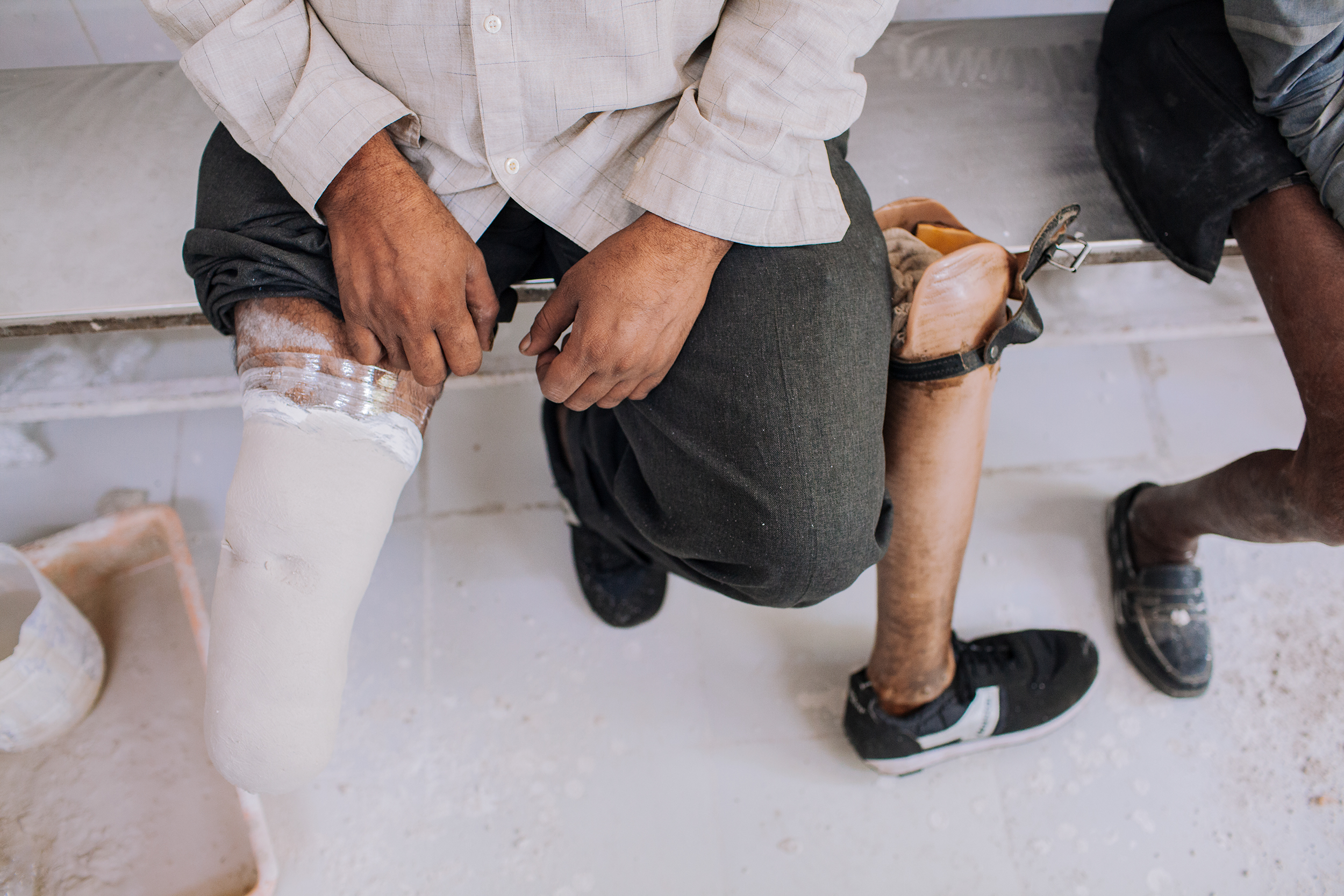  A negative mold of patient’s limb is being made to customize his prosthesis. 