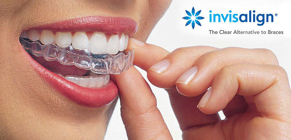 LAKESIDE ORTHODONTICS in Wädenswil near Zurich propose Invisalign braces for adults for a discreet correction of the tooth placement.
