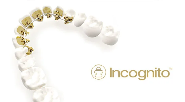 Incognito Hidden Braces are placed behind your teeth, so no one will ever know that you are wearing them. Perfect for adults, these braces are discreet and effective to straighten your teeth.