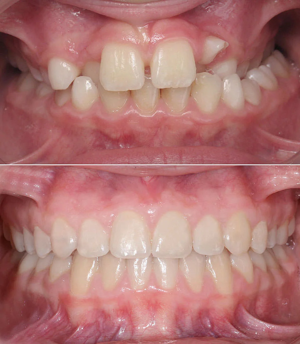 After the successful orthodontic correction of the patient's Crossbite at LAKESIDE ORTHODONTICS in Wädenswil near Zurich.