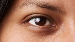 3 Tips/Ways to Remove Dark Circles