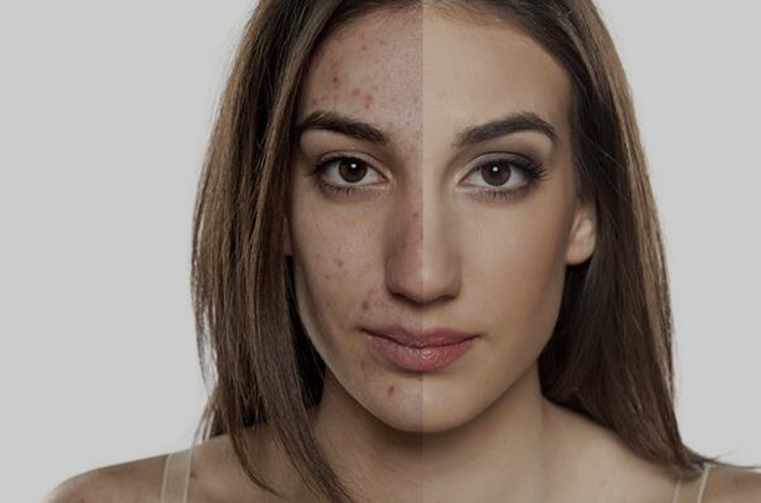 Makeup Tips for Brides with Acne-Prone Skin 