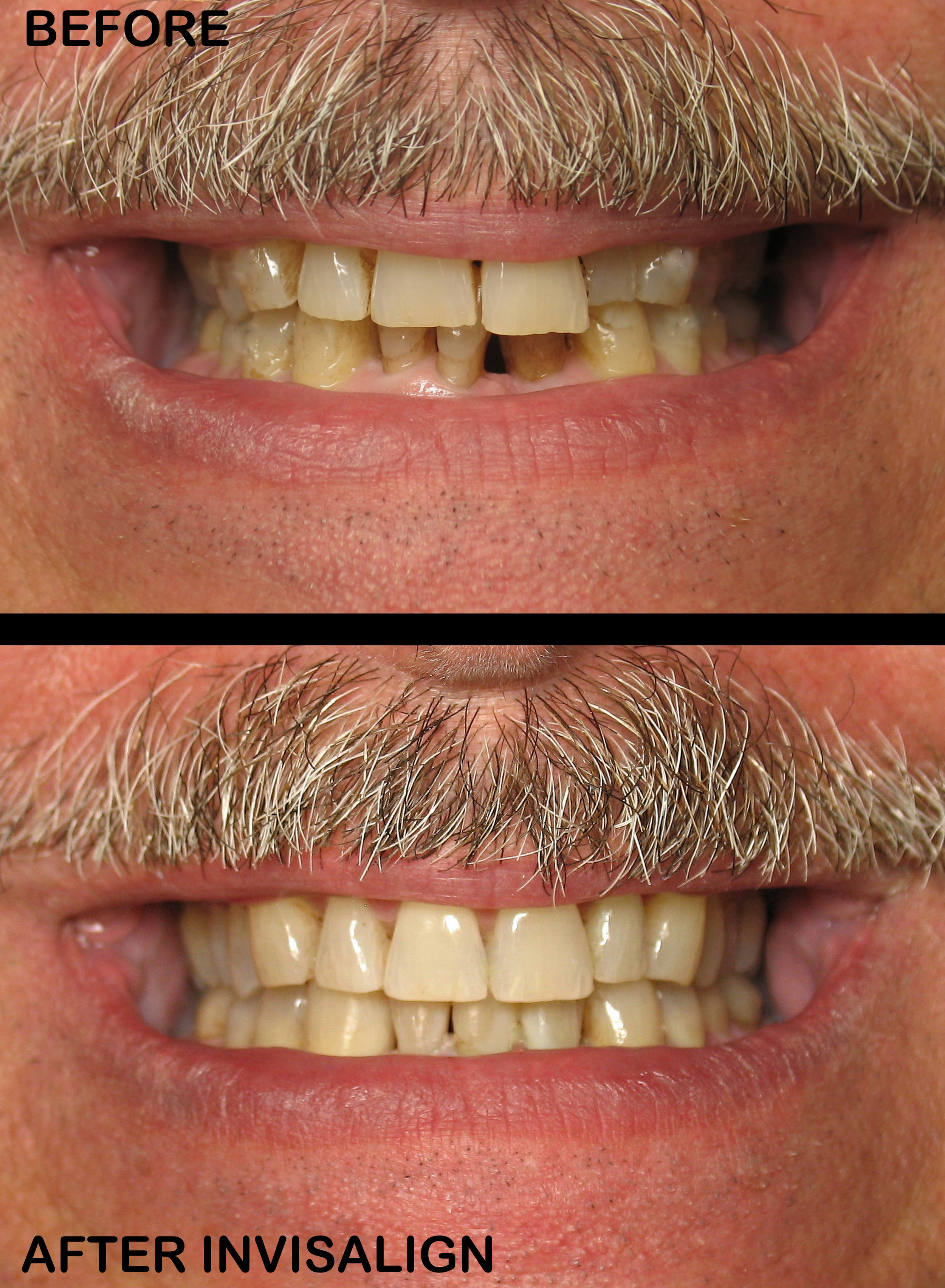 Invisalign (3).jpg