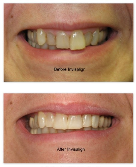 Invisalign  (10).jpg