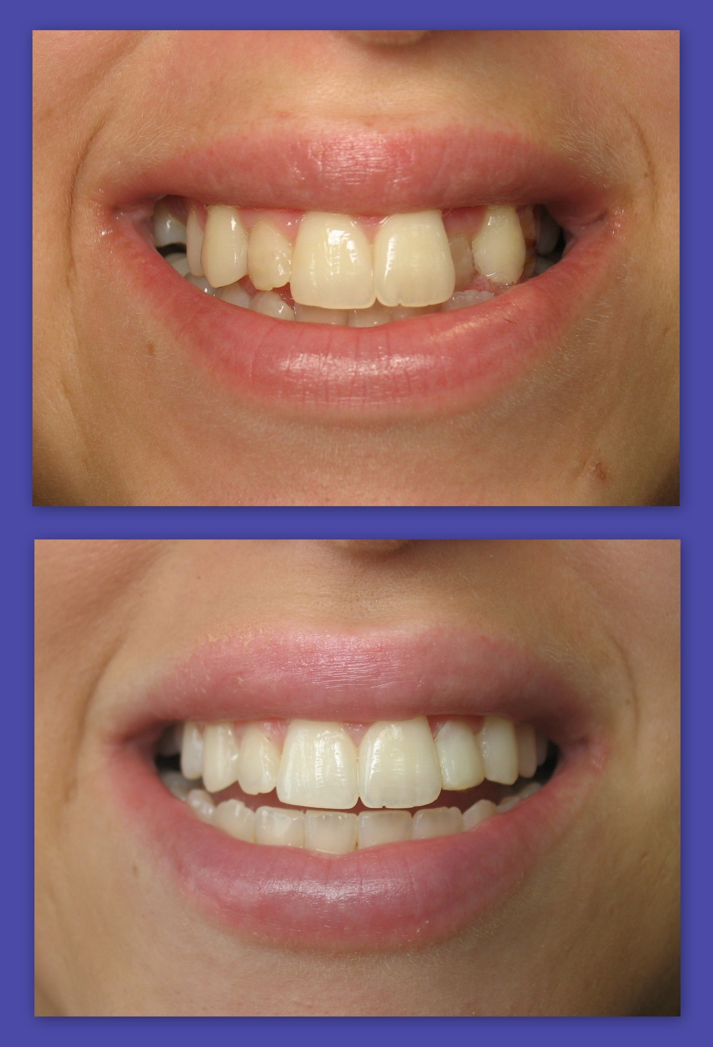 Invisalign (11).jpg
