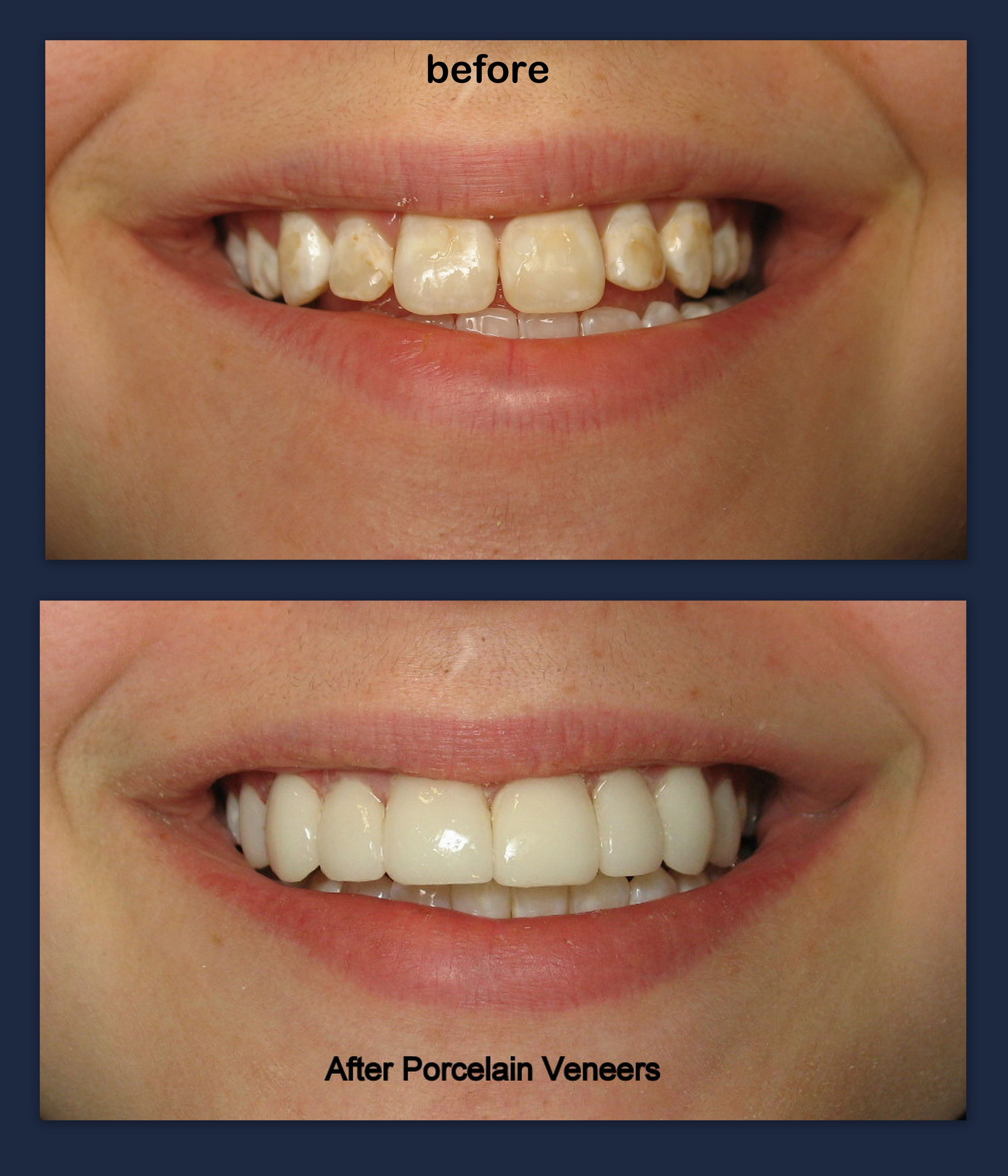 Porcelain Veneers (2).jpg