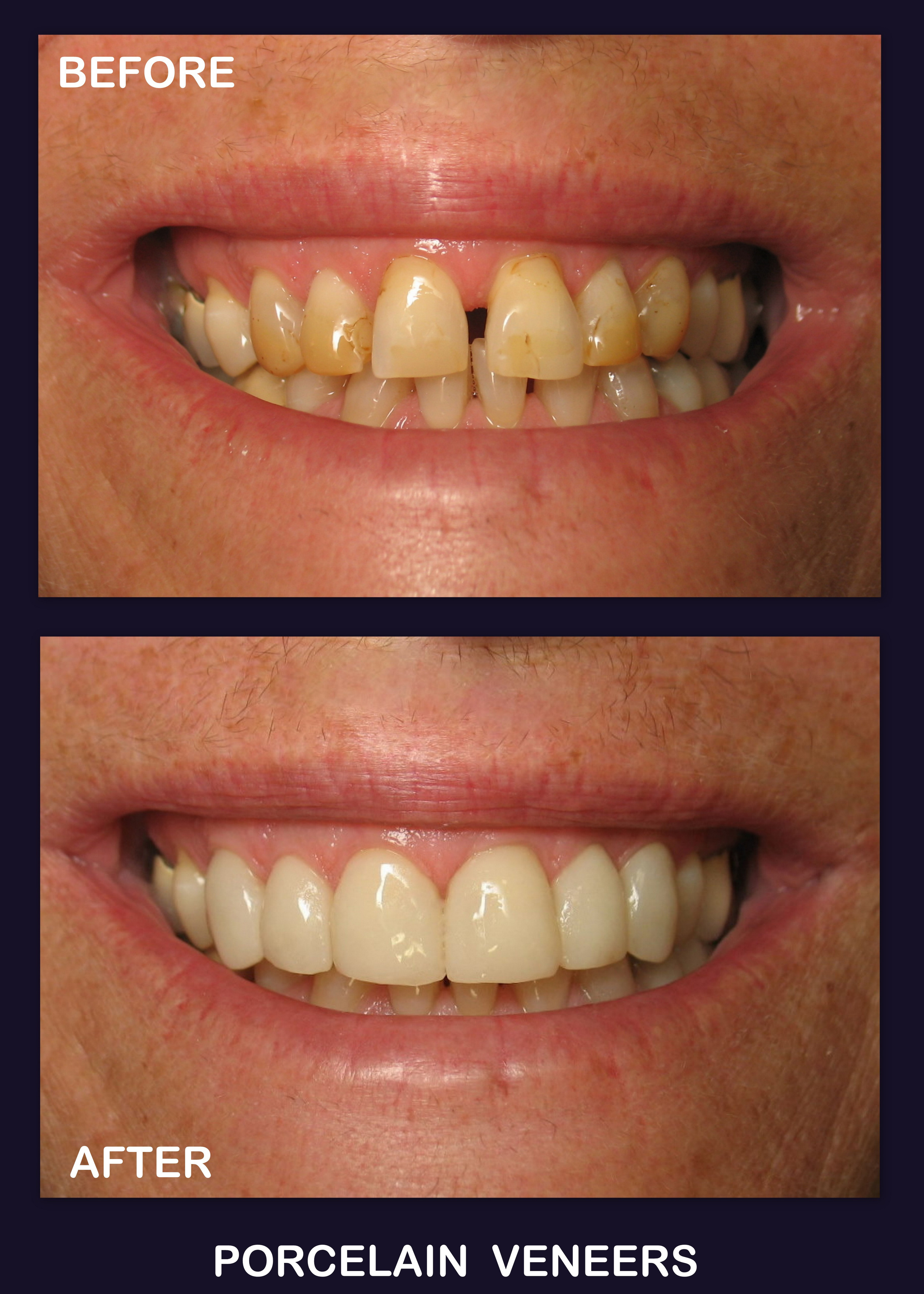 Porcelain Veneers (3).jpg