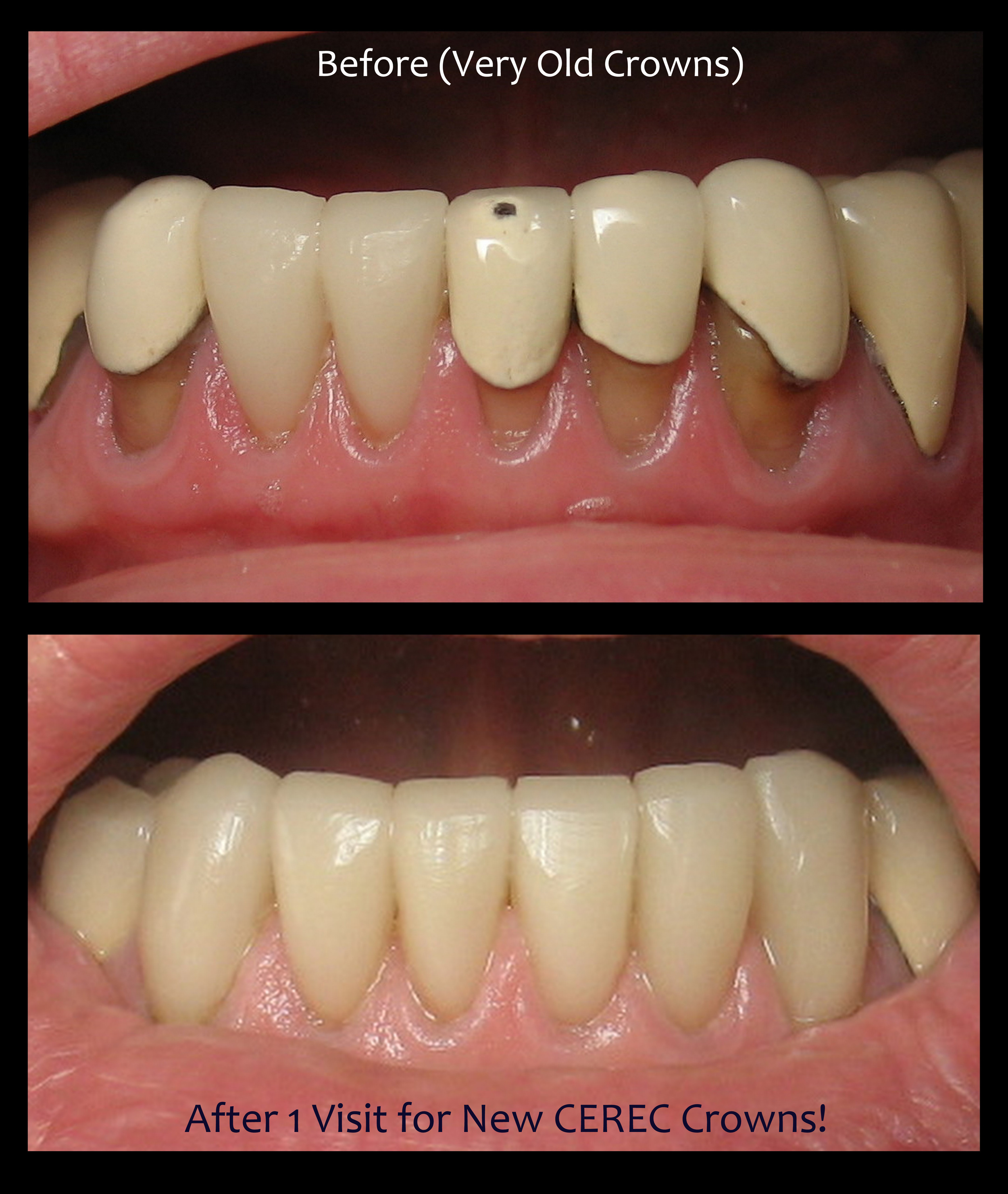 cerec crowns before and after cerec crowns before and after